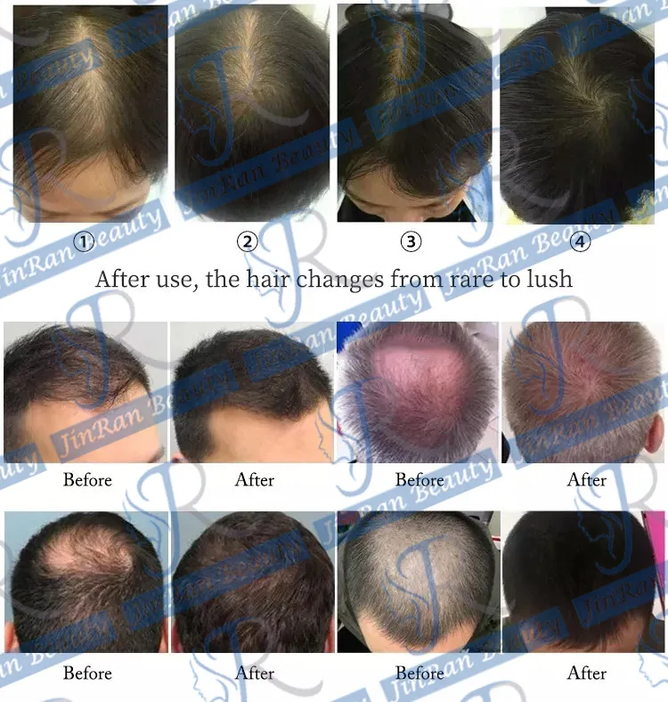 Multifunctional Co2 Laser Hair Growth Machine With Scalp Detection