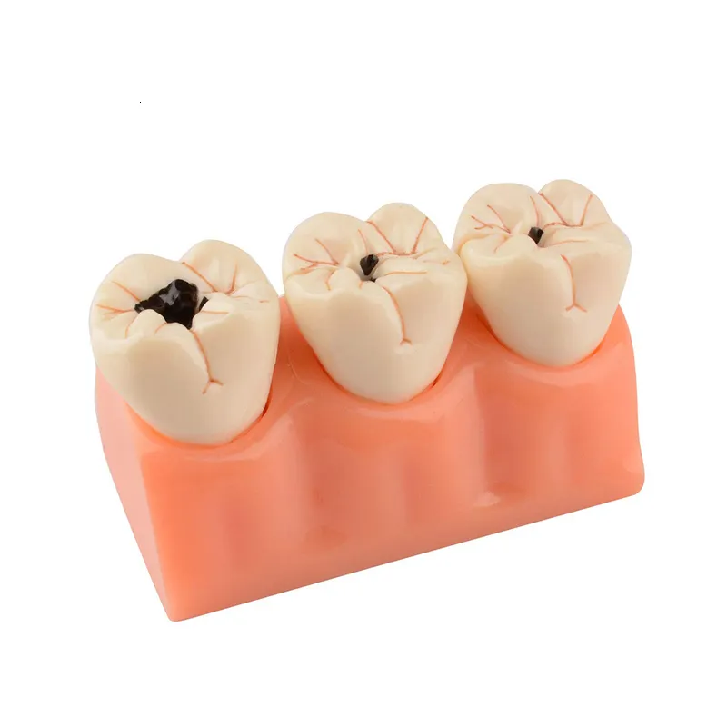 Other Oral Hygiene Dental Decayed Teeth Model Denture Caries Disease Tooth Model Decomposition Decay Tooth Model Dentist Teaching Tools 230815