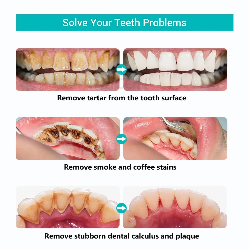 2023 Inne Higiena jamy ustnej Zęby dentystyczne Usuwanie kamienia nazębnego Czyszczenie ultradźwiękowe Płytka nazębna Kamień nazębny Soniczny środek czyszczący do zębów Kamień_voghion.com