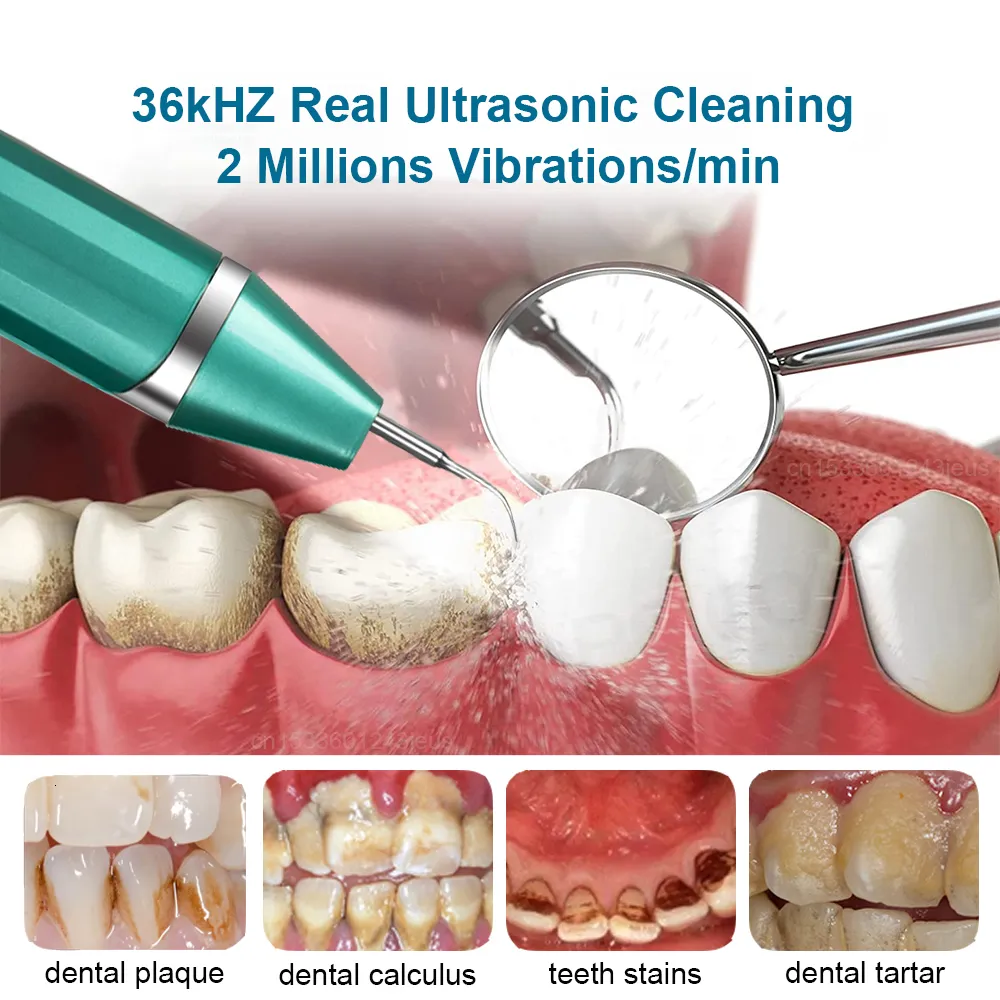 2023 Inne Higiena jamy ustnej Zęby dentystyczne Usuwanie kamienia nazębnego Czyszczenie ultradźwiękowe Płytka nazębna Kamień nazębny Soniczny środek czyszczący do zębów Kamień_voghion.com