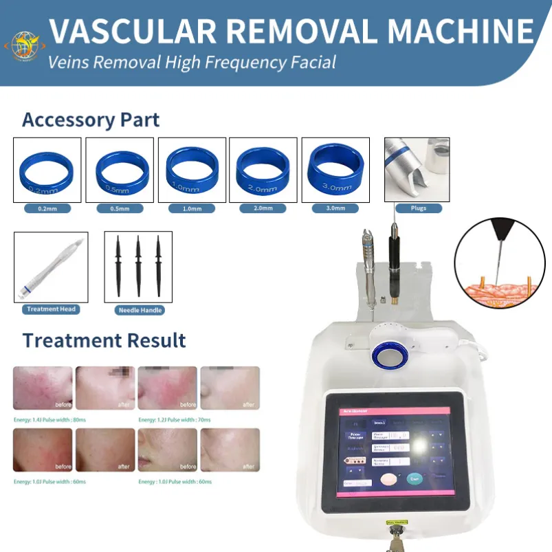 レーザーマシン驚くべきスパイダー静脈除去ペン静脈静脈血管除去レーザー処理機の価格
