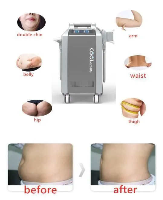 4-Handle Double Channel Cryolipolysis Fat Freezing Machine for Body Slimming