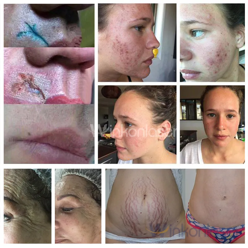 Co2 Laser En El Rostro Rejuvenecimiento Facial Laser CO2 Bogota