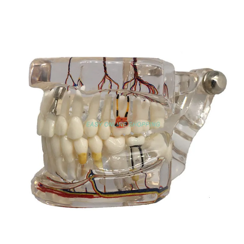 Andere mondhygiëne tandheelkundig tandenmodel met zenuw geïmplanteerde transparant pathologisch reparatieonderwijs Demonstratiemodel 230506