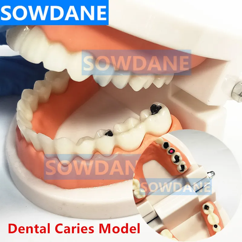 Andere orale hygiëne Dental Tand Model Tanden Model Dental Cariës Model voor studiemodel voor patiëntcommunicatie Tandarts met vervallen tand 230524