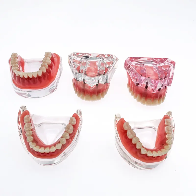 Andere mondhygiëne tandheelkundige tandenmodel met implantaten Overdenture Superior demo -model voor student tandarts Patiëntcommunicatiemodel 230524