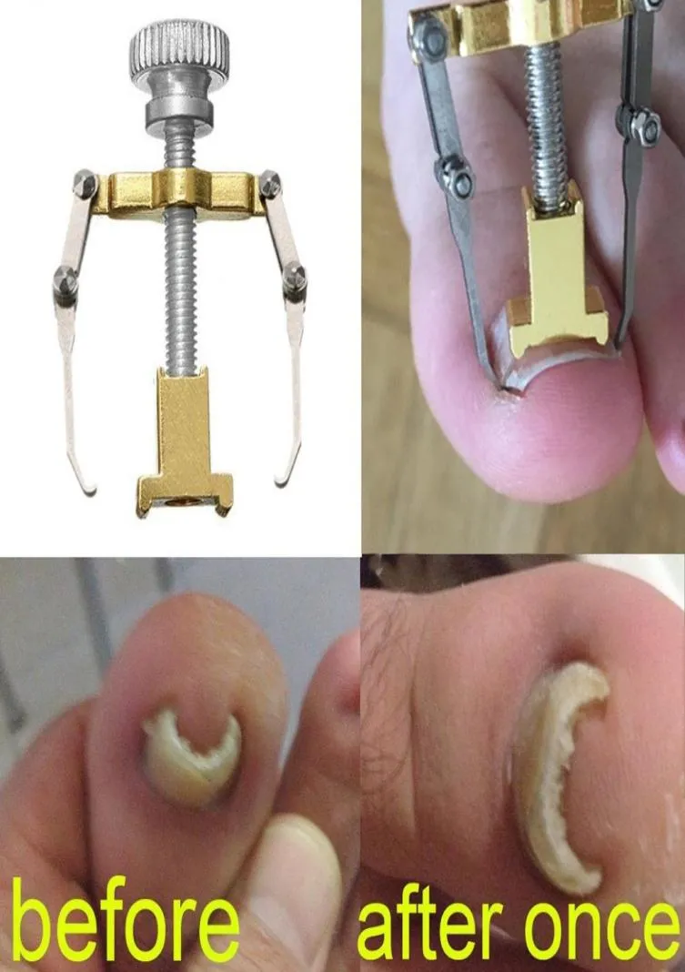 Correcteur d'ongle incarné, pédicure d'orteil, outils de soins des ongles, traitement de pédicure en acier inoxydable, outil de Correction d'oignon Onyxis9990960