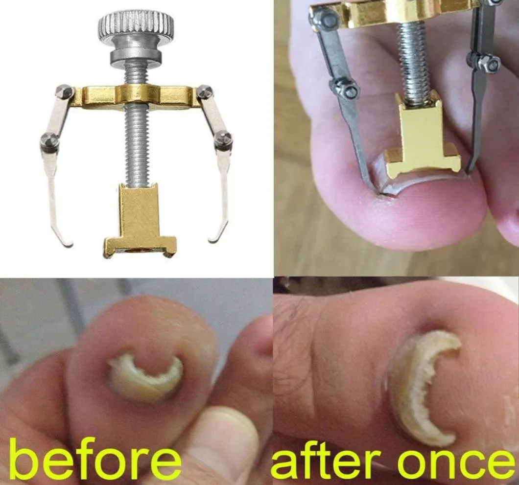 Wrośnie korektor palców stóp paznokci narzędzia pielęgnacji paznokci narzędzia gwoździowe stali nierdzewne leczenie Pedicure Correction Correction Correction 6276030