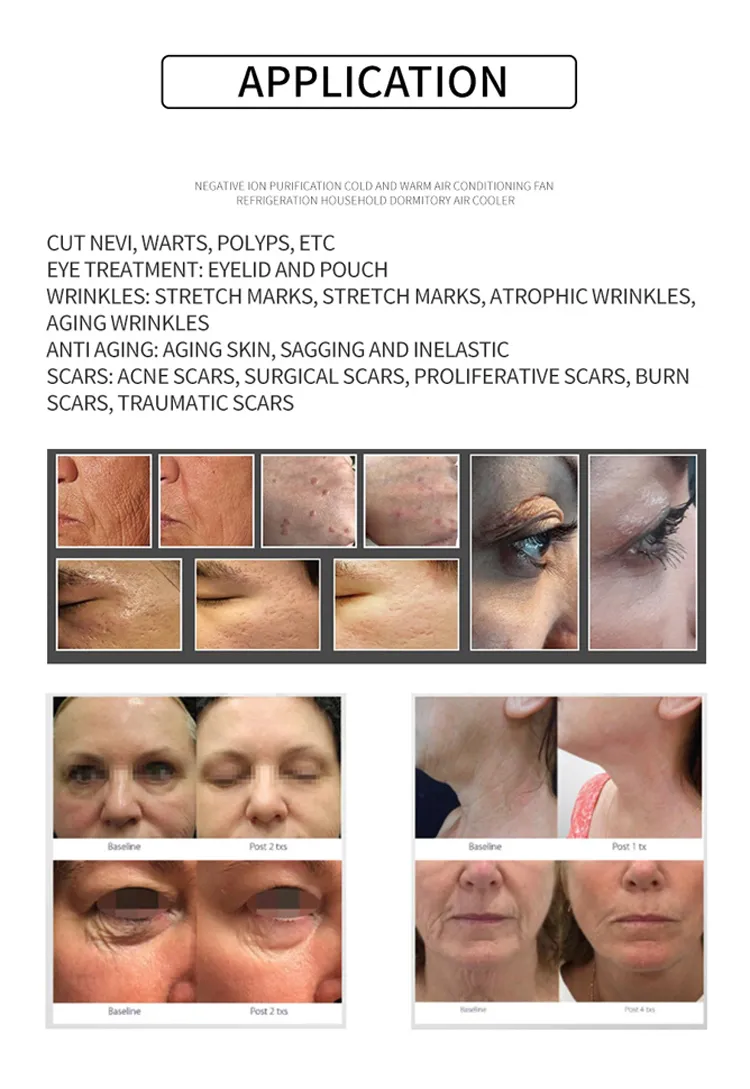 3 Handles 3 IN 1 Fractional Plasma Device Skin Care Firming Neck Facial Lifting Anti-aging Stretch Marks Anti-wrinkle Lifting 25 Pins Plasma Pen Machine 3 IN 1 Fractional Plasma Pen Device |Honkay plasma pen fibroblast professional,plasma pen skin tag & mole remover,plasma pen
