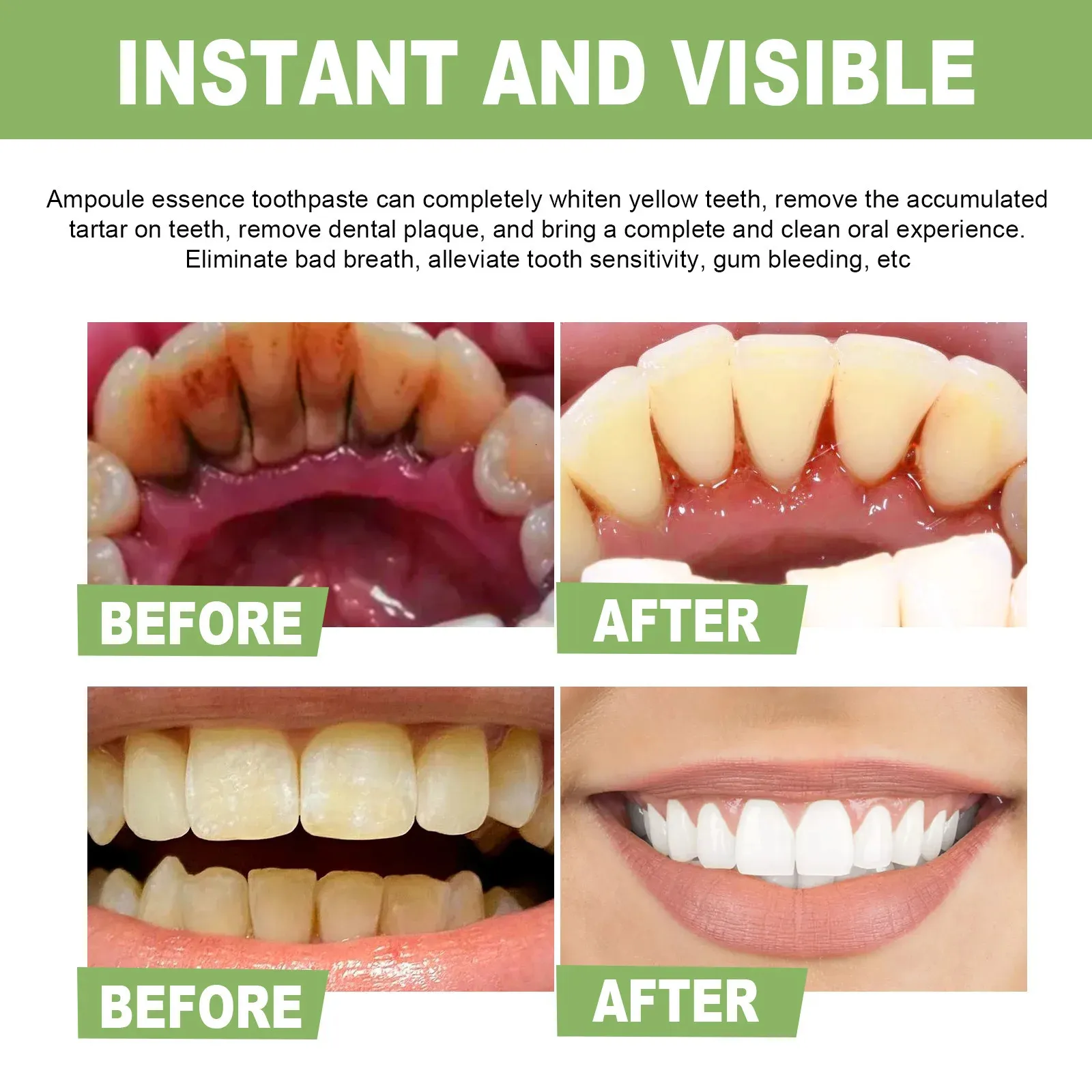 Altro Igiene Orale Pulizia Dei Denti Siero Rimozione Tartaro I