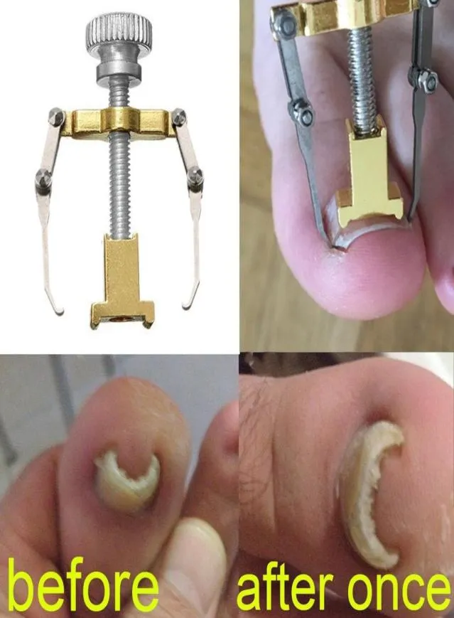 Correttore per unghia del piede incarnita Pedicure del piede Strumenti per la cura delle unghie Trattamento per pedicure in acciaio inossidabile Strumento per la correzione dell'alluce valgo6710278