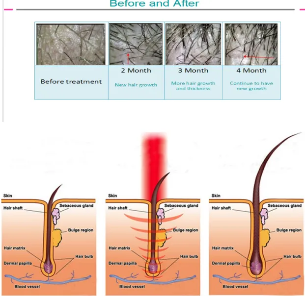 Best anti hair loss and alopecia areata treatment 650nm diode laser hair regrowth laser hair growth machine for beauty salon