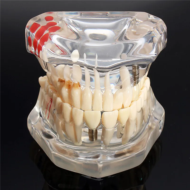 Autre modèle de dents de maladie dentaire d'implant d'hygiène buccale avec dentiste de dent de pont de restauration pour l'outil d'étude d'enseignement des sciences 230228