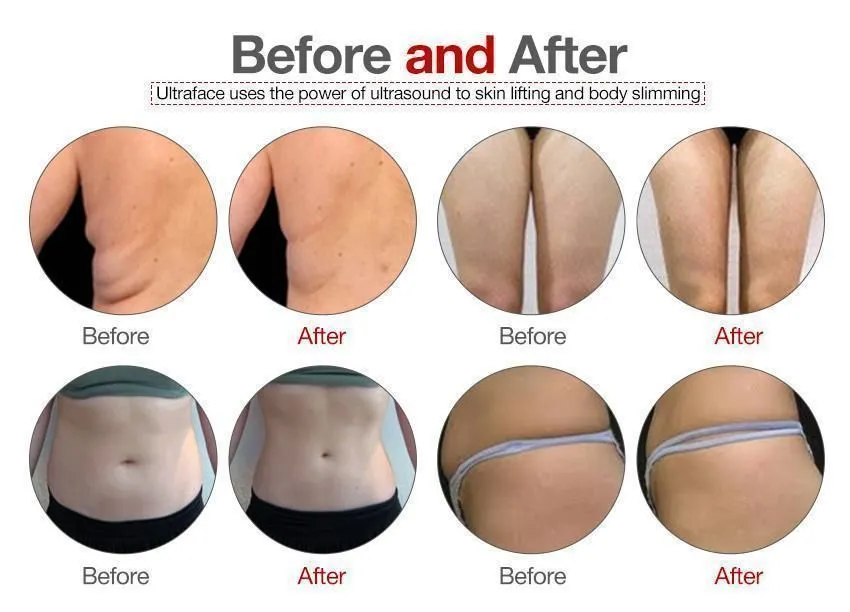 fat freezing before and after