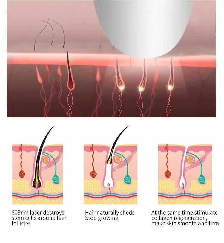 Quick effect and permanent hair removal 808nm diode laser machine