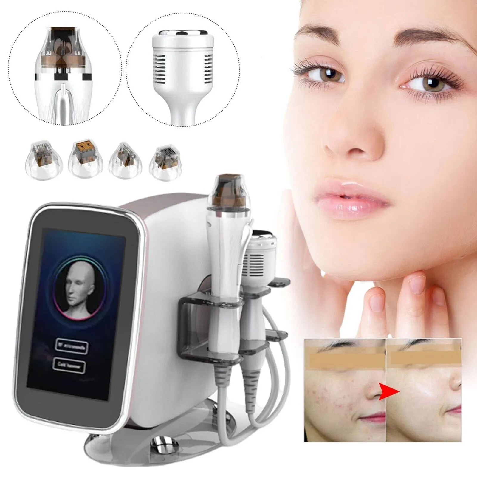2 in 1 Fractional RF Microneedling Machine With Cryo Cold Hammer Stretch Marks Scar Remover 10pin 25pin 64pin and Nano Micro Needle Treatment For Skin Face Body Lift