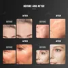 HIEMT Professional Skin Resurfacing Device EMS 14 Tesla Skin Rejuvenation Muscle Toning Skin Tightening Face Lifting Reduce Wrinkles EMS Muscle Tightening Device