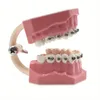 Modello di denti ortodontici dentali da 1 pezzo con dimostrazione di studio su tubi con staffa metallica