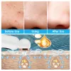 Removers Blackhead Remover Acne Facial Bubble Cleaner Suge Black Point dammsugare Rengörare Sebum Inhaler Squeeze Acne Black Dots Extractor