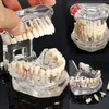 Artes e ofícios modelo de dentes de doença de implante dentário com ponte de restauração dentista para ensino de ciências study1251h