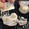 Modèle de dents de maladie d'implant dentaire d'arts et d'artisanat avec le dentiste de dent de pont de restauration pour l'étude d'enseignement des sciences 12119