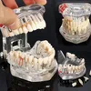 Modelo de dentes para doença de implante dentário, com ponte de restauração, dentista para ciências médicas, ensino de doenças dentárias, estudo 266i