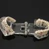 Dental Implant Disease Teeth Model With Restoration Bridge Tooth Dentist For Medical Science Dental Disease Teaching Study268s