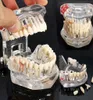 Dental Implant Disease Teeth Model With Restoration Bridge Tooth Dentist For Medical Science Dental Disease Teaching Study4157995