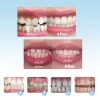 Kieferorthopäde Zahnspangen Zahnspangen Lächeln Zähne Ausrichtungstrainer Instanted Silikonzähne Retainer -Schutzhandschale für Kinder