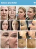 RF Micro Needling Fractional Inmode Morpheues8 Matrix Dot Fraktionerad radiofrekvens Kristallit Djup Skin åtdragning Ansiktsskylt Remover Spa -enheter