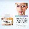 Kurkume gezichtshuid reparatie crème acne behandeling gezicht moisturizer bleken bliksem tegen acne removercrème