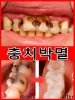 Dentalkaries Reparatur Serum verhindern Zähne Verfall Schutzzähne Entfernen Sie Plaque orale Reinigung natürlicher Kräuterextrakt 30ml