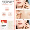 Pimple Patch Face Spot Scar Care Acnes 144pcs Face Care Moisturizing Treatment Pimple Scar Acne Spot Invisible Stickers