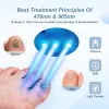 Nail Fungal Nail Laser Réparation des ongles rapides Champignon Onechomycose Réparation de l'ongle Fingernail REPLOS