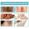 Acanthosis Fixderma nigrifix Cream Dark Spot Corrector Cream Acanthosis Nigricans Therapy Cream Nigricans Therapy Cream