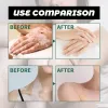 Vitiligo Repair Ointment Herbal Removal Ringworm White Spot Cream Eliminate Get Rid Of Skin Vitiligo Health Skin Care Products