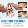 Vitiligo Repair Ointment Herbal Removal Ringworm White Spot Cream Eliminate Get Rid Of Skin Vitiligo Health Skin Care Products