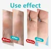 4pcs/Set Holzgriff Fuß Kallus -Rasierer Fersen Füße Haut Rasierer Mais Nagelhaut Cutter Remover Raspe Pediküre Rasiermesser tragbare Fußpflege