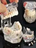 Arts And Crafts Dental Implant Disease Teeth Model With Restoration Bridge Tooth Dentist For Science Teaching Study16497831