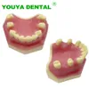 Zahnärztliche Implantat Zahnmodell Praxis Demo Typodont für Zahnarztstudenten, die Lehrmodelle studieren, Zahnmedizin Laborprodukte