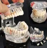 Modelo de dentes de doenças do implante dental de artes e ofícios com Dentista de dente de Bridge para Estudo de Ensino de Ciências13999626