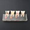 Dental Diş Modeli M4018 Endodontik Tedavi 4 Evreli Molar Kök Kanal Boyazları Öğretimi incelemek için