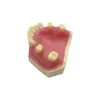 Zahnärztliche Implantat Zahnmodell Praxis Demo Typodont für Zahnarztstudenten, die Lehrmodelle studieren, Zahnmedizin Laborprodukte