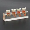 Dental Diş Modeli M4018 Endodontik Tedavi 4 Evreli Molar Kök Kanal Boyazları Öğretimi incelemek için