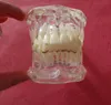 Dental Teeth Pathology Model With Half Implant visar tydligt den ursprungliga formen och hela strukturen1990056