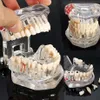 Kunsthandwerk zahnärztliche Implantat -Zähnemodell mit Restaurierungsbrückenzahn Zahnarzt für Wissenschaftsunterrichtsstudie1257K