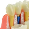 歯科訓練モデル4回歯インプラント分析歯科医学科学教育のためのクラウンブリッジ取り外し可能なモデル