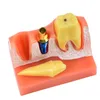歯科訓練モデル4回歯インプラント分析歯科医学科学教育のためのクラウンブリッジ取り外し可能なモデル