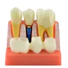 歯科訓練モデル4回歯インプラント分析歯科医学科学教育のためのクラウンブリッジ取り外し可能なモデル