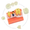 歯科訓練モデル4回歯インプラント分析歯科医学科学教育のためのクラウンブリッジ取り外し可能なモデル